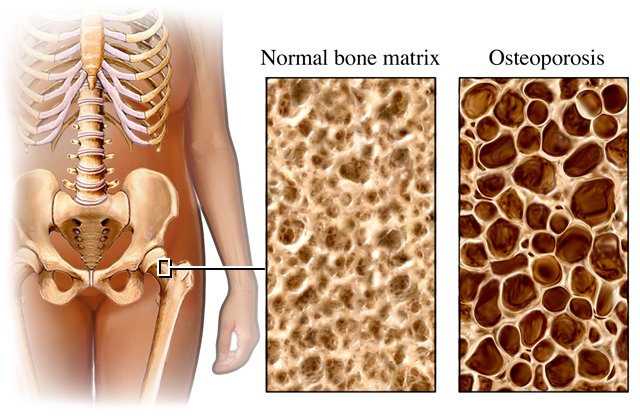 Exercise In The Prevention And Management Of Osteoporosis
